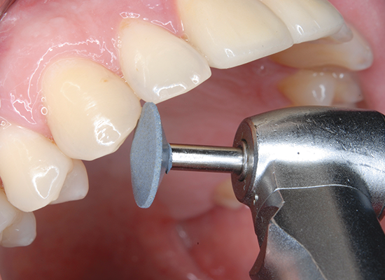 SHOFU Dental Corporation CeraMaster Coarse and CeraMaster