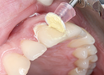 SHOFU Dental Corporation Super-Snap Buff Disk and Mini Buff Disk