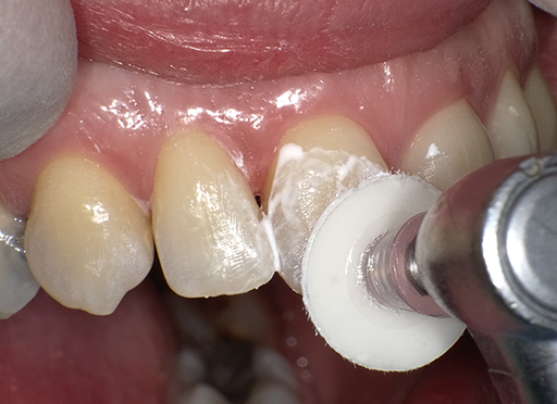 SHOFU Dental Corporation Super-Snap SuperBuff Disk